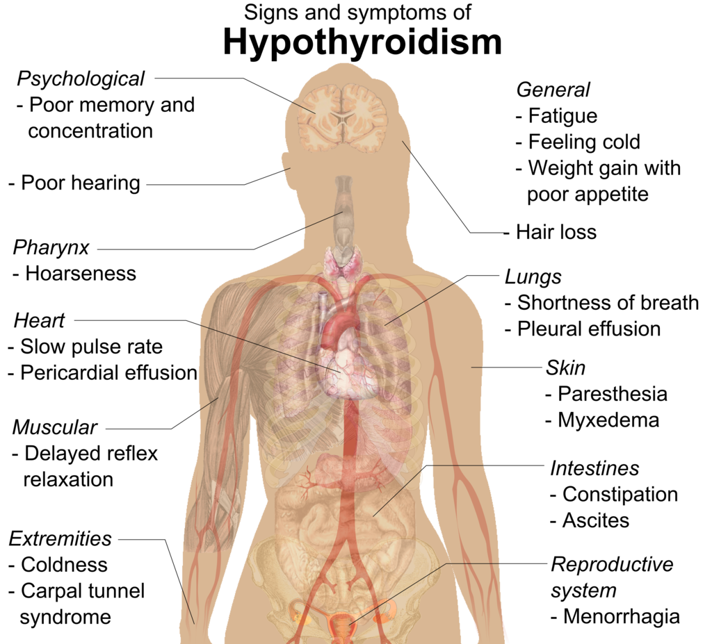 Signs of Hypothyroidism (Wikimedia Commons)