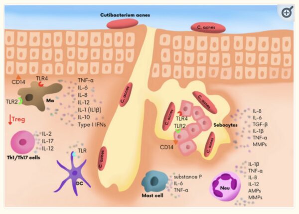 Acne: Root Causes & Personal Solutions