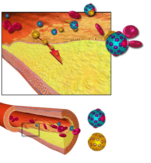 ldl cholesterol