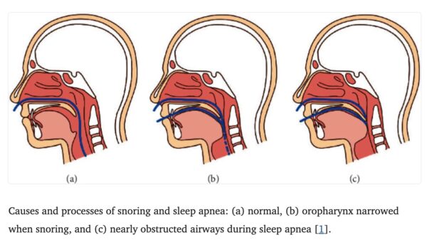 Snoring Types Snoring: Genes and Solutions